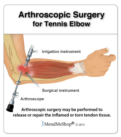 Tennis elbow treatment steroid injection