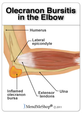 Steroid injection in elbow